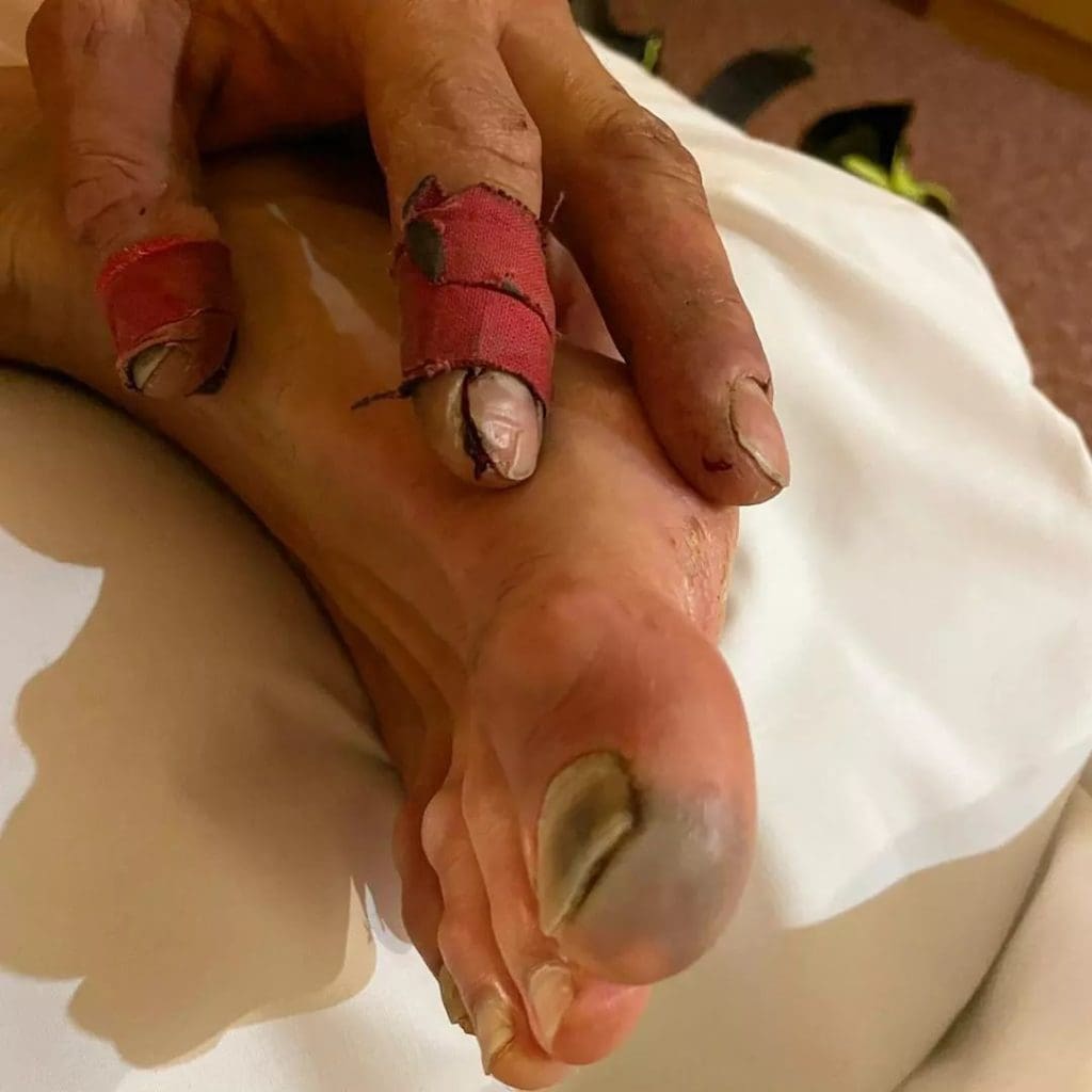 Toes and fingers have been badly affected. (Picture Charles Dubouloz)