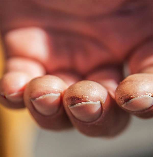 Sébastien-Berthe-Siebe-Vanhee-Dawn-Wall-damaged-fingers