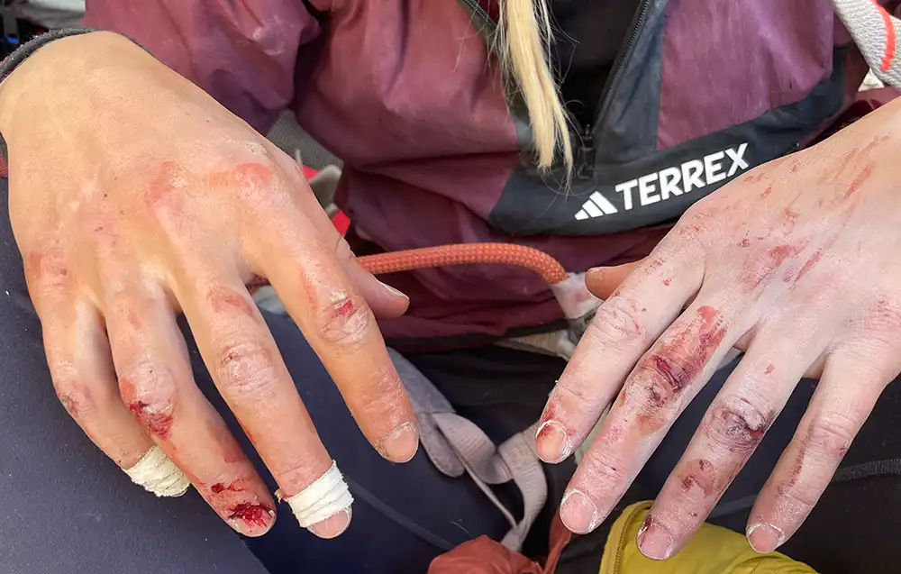 Die geschundenen Finger von Lara Neumeier sprechen für sich.